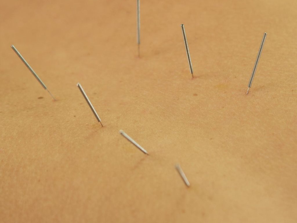 Understanding the Power of Sunrise Acupuncture in Prevention for Health